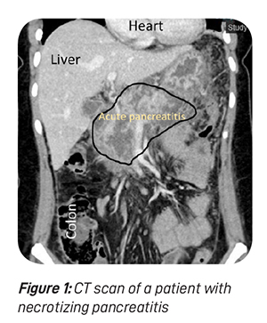 The-Inflamed-Pancreas-Fig-1.jpg
