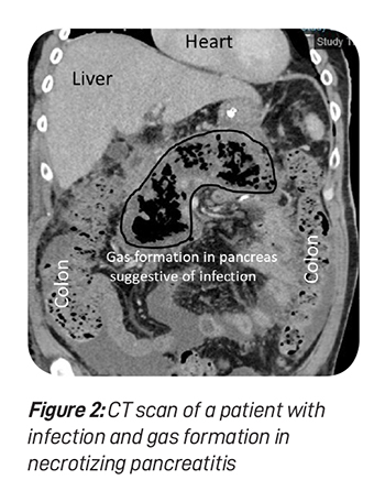 The-Inflamed-Pancreas-Fig-2.jpg