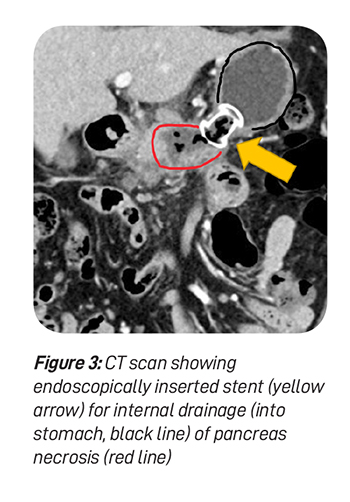 The-Inflamed-Pancreas-Fig-3.jpg