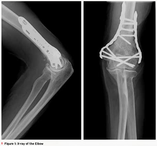 Improving Function for Elderly Fractures
