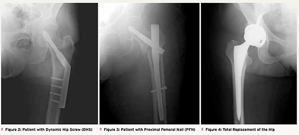 Improving Function for Elderly Fractures