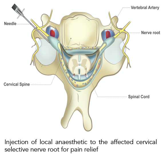 Cervical Radicular Pain (Brachialgia) 3.png