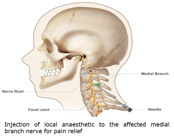 Chronic Neck Pain (Cervical Facet Joint Pain).png