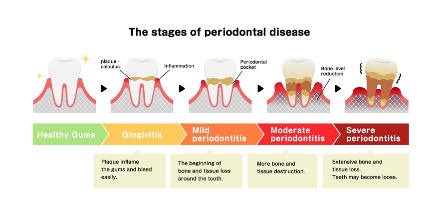 Gum Disease 1.jpg