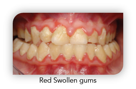 Gum Disease 2.png