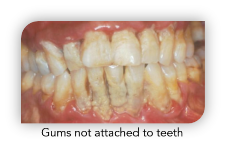 Gum Disease 3.png