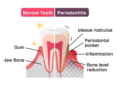 Gum Disease 4.jpg