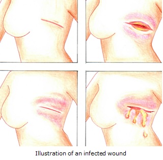 Breast Wound Care 2.jpg