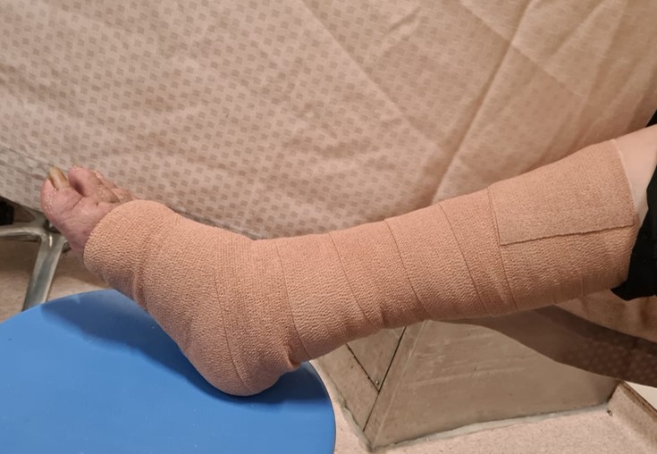 Care of Compression Bandage for Venous Leg Ulcer (VLU) 1.tif