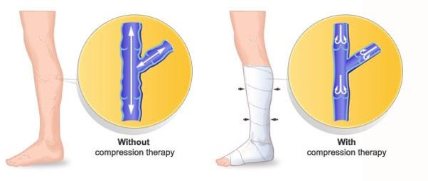 Care of Compression Bandage for Venous Leg Ulcer (VLU) 2.jpg