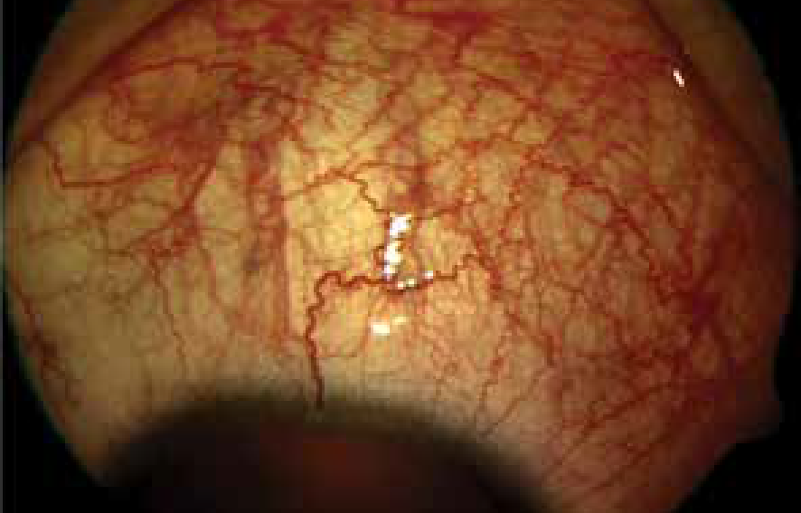 Episcleritis and Scleritis 3-01.png