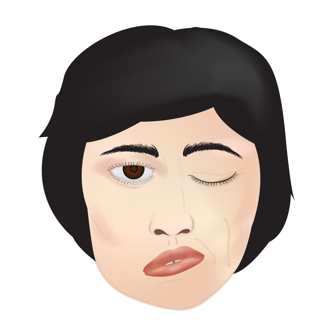 Hemifacial Spasm 1-01.png