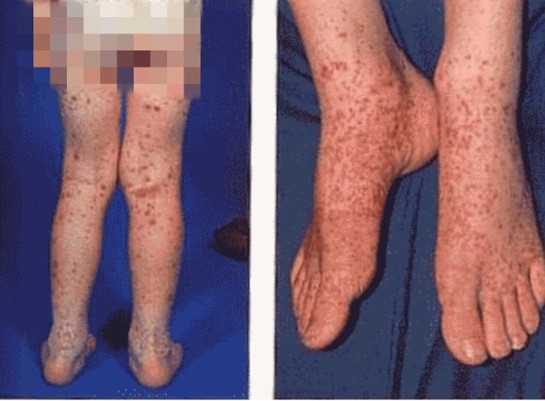 HenochSchönlein Purpura (HSP)