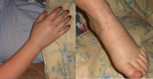 HenochSchönlein Purpura (HSP)