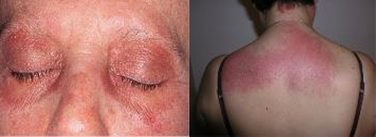 Inflammatory Myopathy