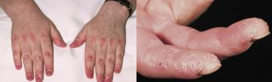 Inflammatory Myopathy