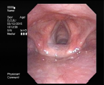 Laryngeal Cancer 1.png