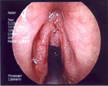 Laryngeal Cancer 2.png