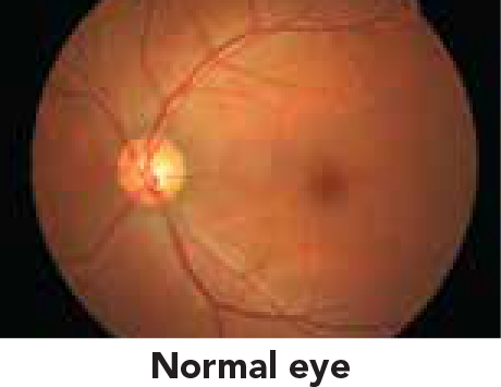Laser Treatment for Diabetic Eye Disease 1.png