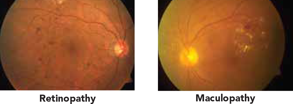 Laser Treatment for Diabetic Eye Disease 2.png