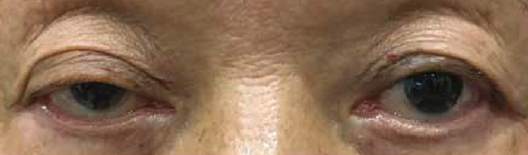 Myasthenia Gravis 1.png