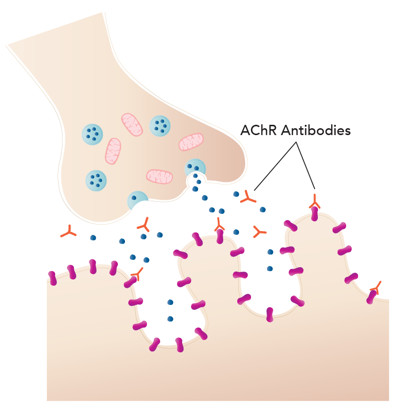 Myasthenia Gravis 3.png