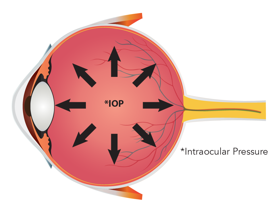 Narrow Angles (Primary Angles Closure Suspects) 2.png