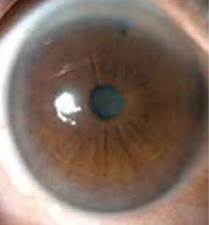 Narrow Angles (Primary Angles Closure Suspects) 4.png