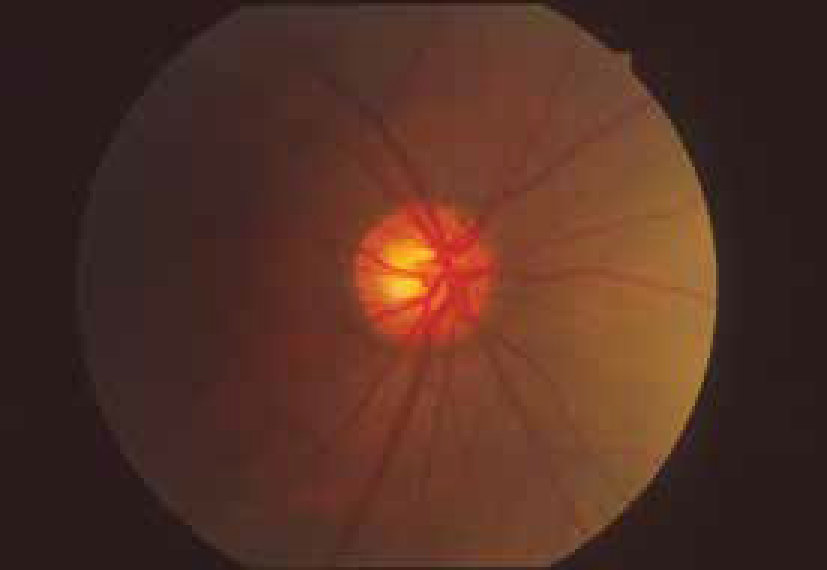 Non-arteritic Anterior Ischaemic Optic Neuropathy (NAION) 2-01.png