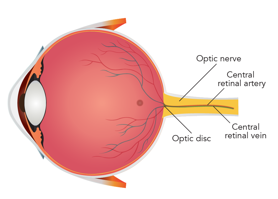 Non-arteritic Anterior Ischaemic Optic Neuropathy (NAION) 3-01.png