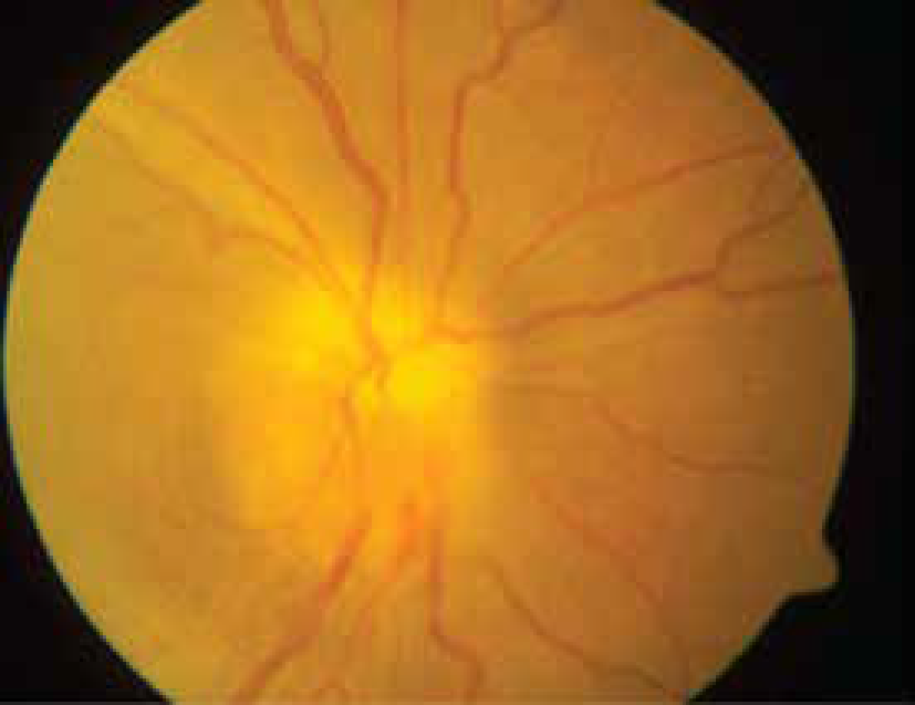 Non-arteritic Anterior Ischaemic Optic Neuropathy (NAION) 5-01.png