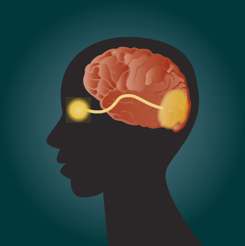 Optic Neuritis 1-01.png