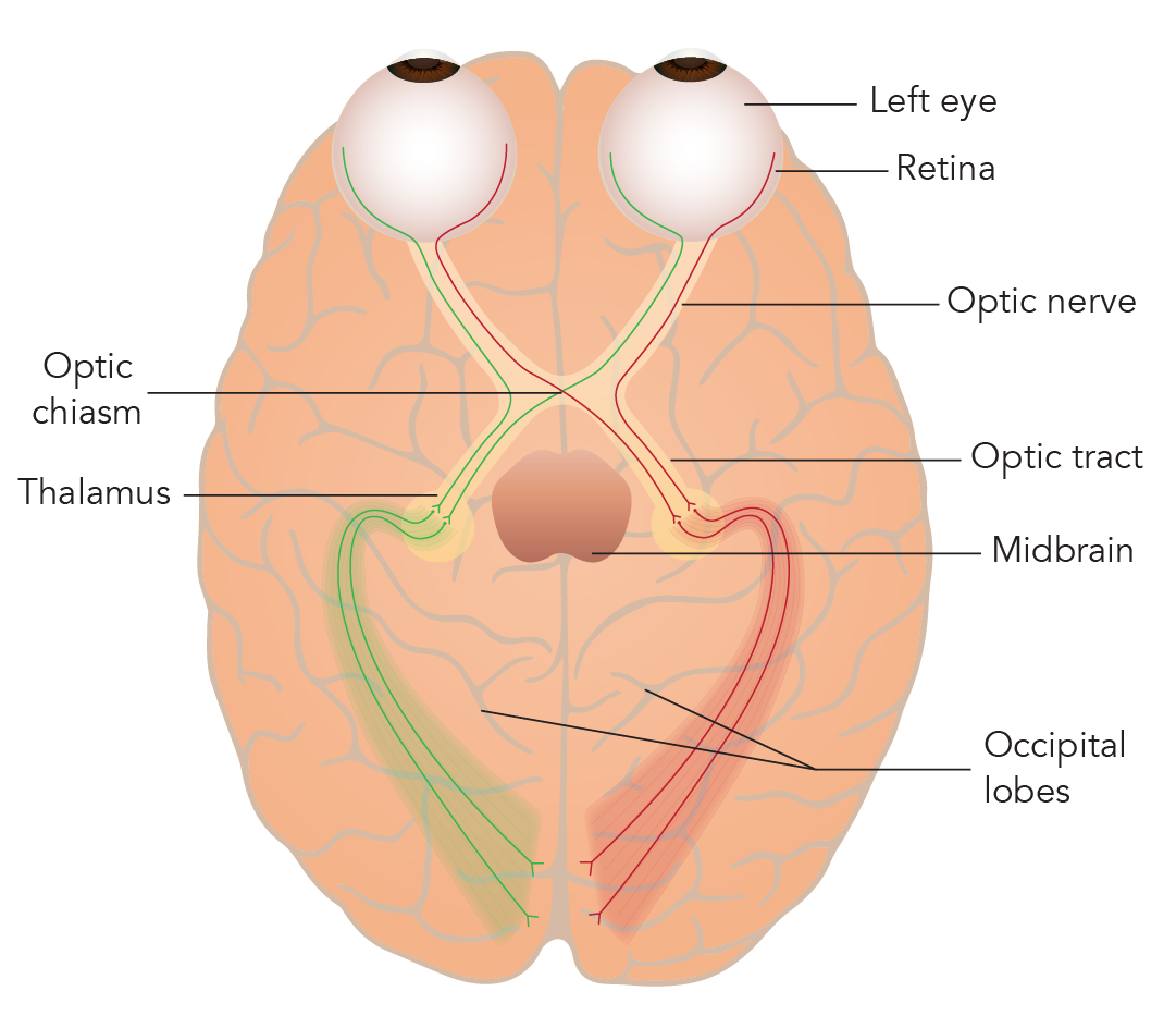 Optic Neuritis 2-01.png