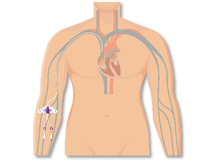 Outpatient Parenteral Antibiotic Therapy OPAT 1.png