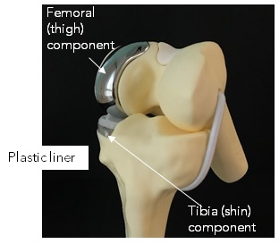 Partial Knee Replacement Prostheses.jpg