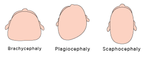 Plagiocephaly 1.png