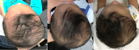Plagiocephaly 4.png