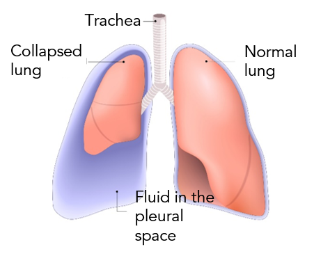 Pleural Effusion 1.png
