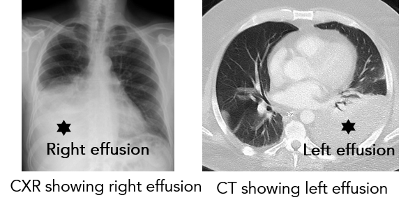 Pleural Effusion 2.png