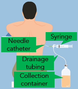 Pleural Effusion 3.png