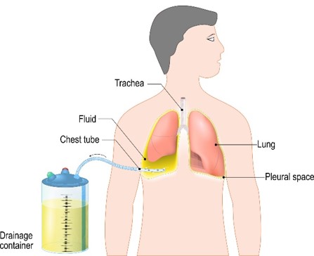 Pleural Effusion 4.jpg