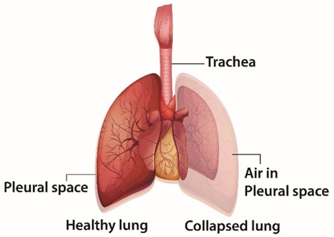 Pneumothorax 1.jpg