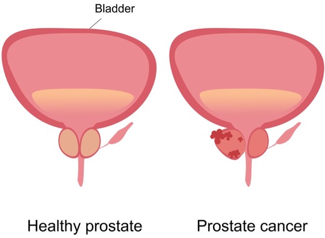 Prostate Cancer-01.png