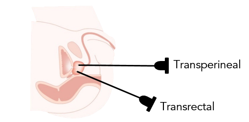 Prostate Gland Biopsy - Transrectal Ultrasound (TRUS) and Transperineal (TP) Biopsy 2.png
