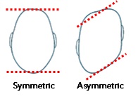 Prosthetics and Orthotics -How Do You Know if Your Child has Plagiocephaly.jpg