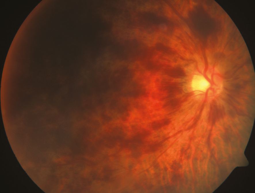Retinal Vein Occlusion 1-01.png