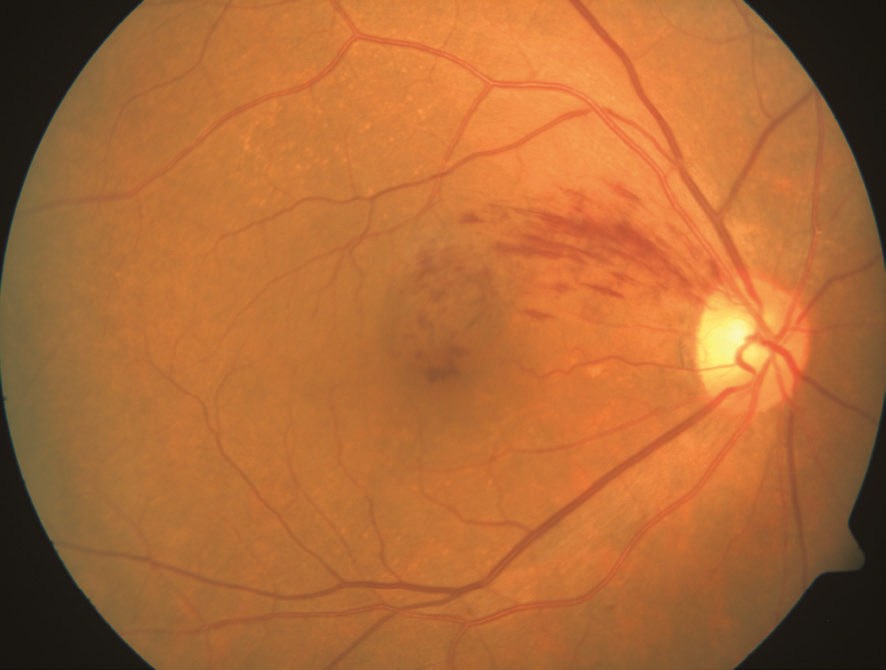 Retinal Vein Occlusion 2-01.png