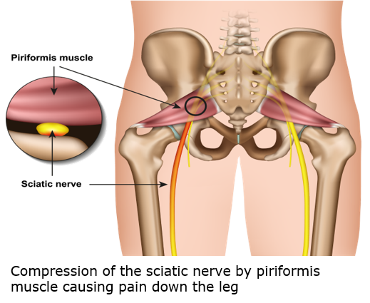 Sacroiliac Joint Pain and Piriformis Syndrome 3.png