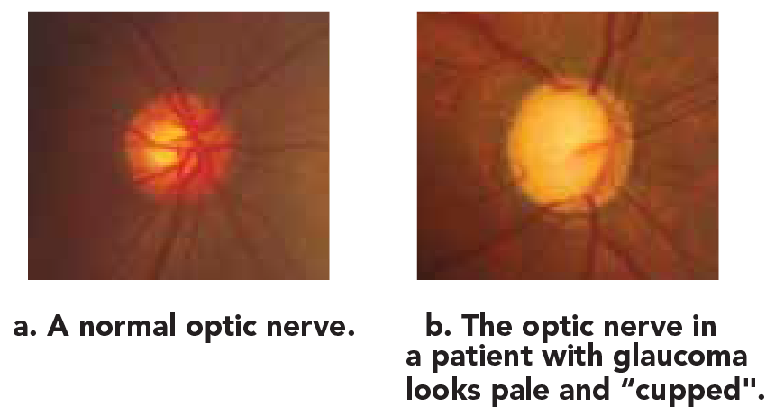 Selective Laser Trabeculoplasty (SLT for Glaucoma) 2-01.png