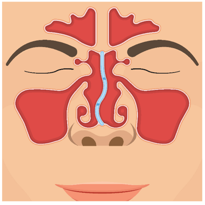 Septoplasty 2.png